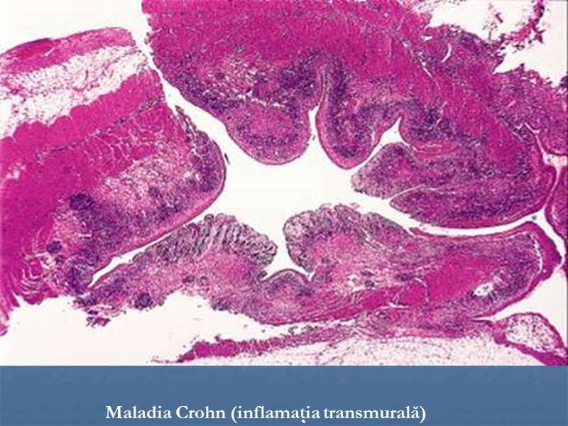 Maladia Crohn (inflamaţia transmurală)